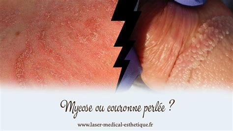 couronne perlée|Traitement des papules perlées du gland